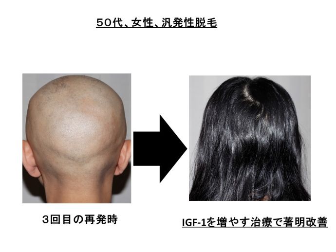 円形脱毛症　病院